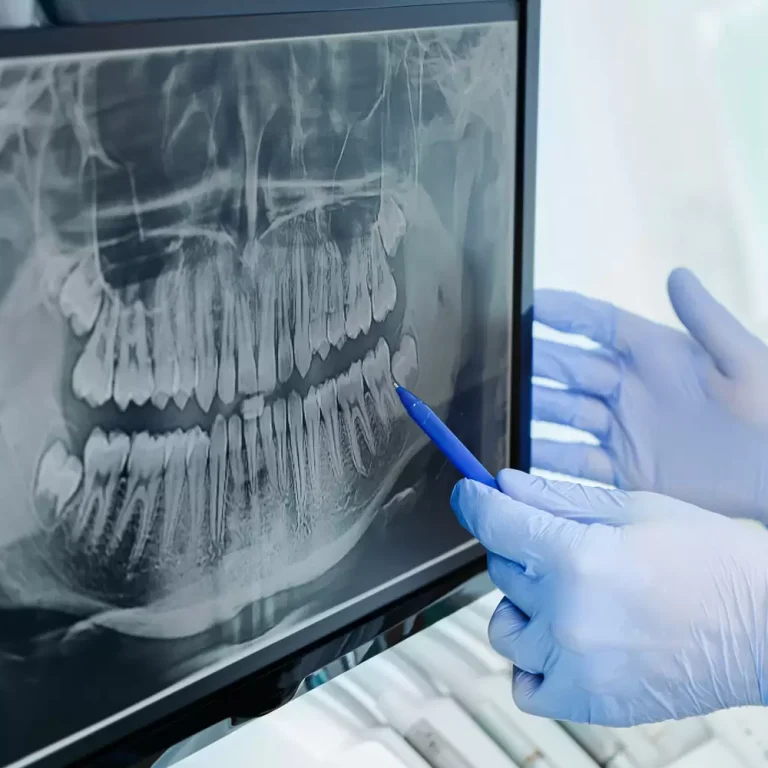 radiografie-dentara-1